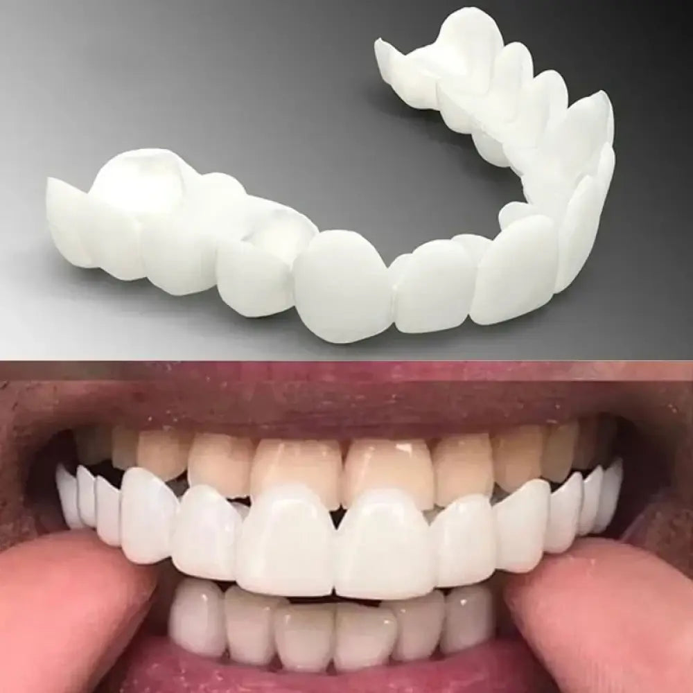 Snap On Smile Veneers (Upper & Lower Included)