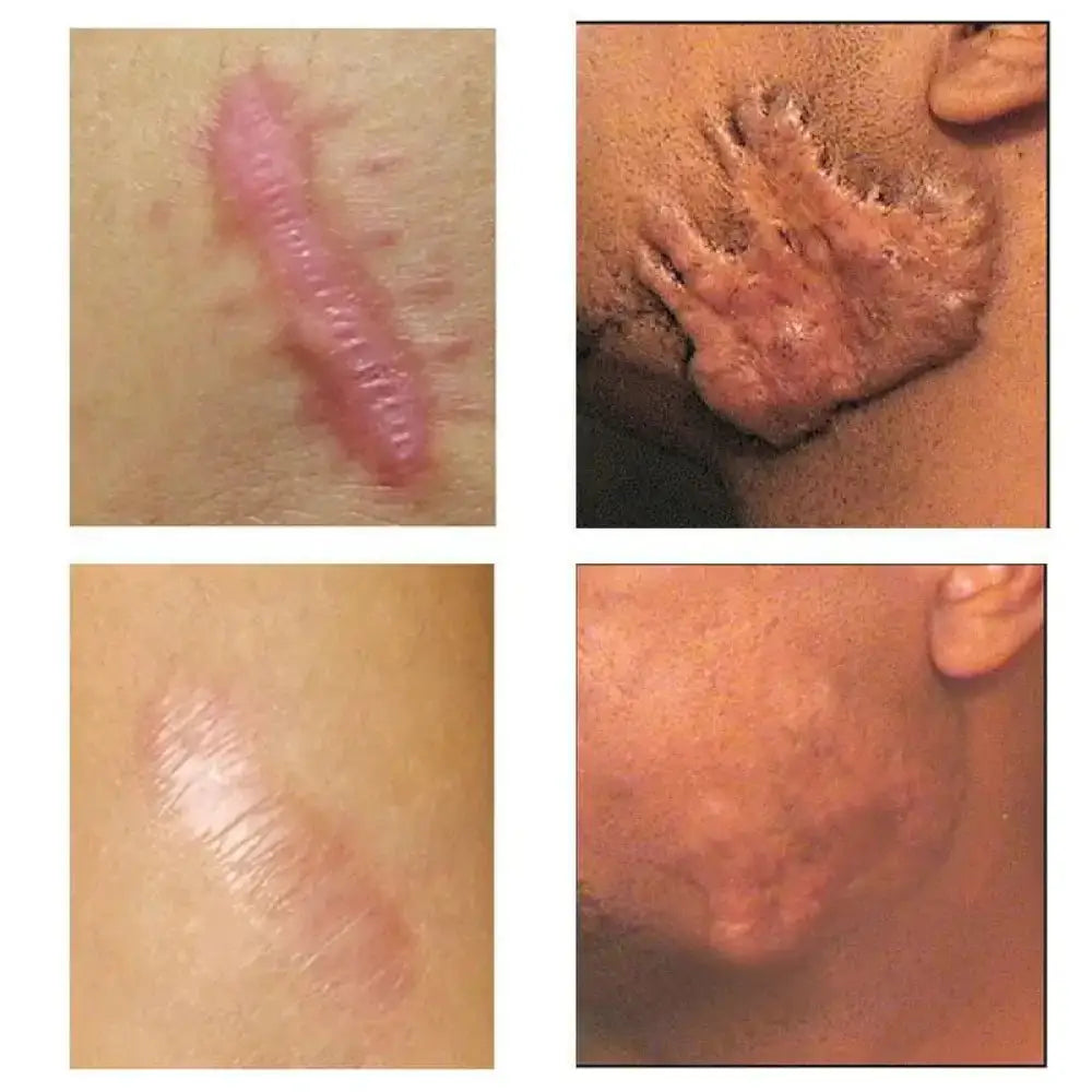 Youthful Scar Remover Cream - Ninjanew