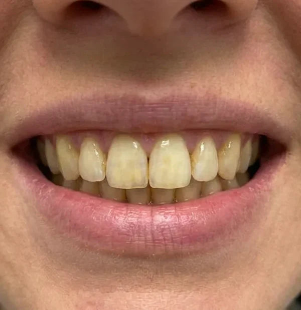 Before - Emily