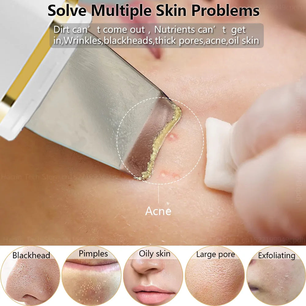 Ultrasonic Skin Scrubber Blackhead Peeling Remover
