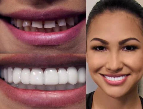 Snap On Smile Veneers (Upper & Lower Included)