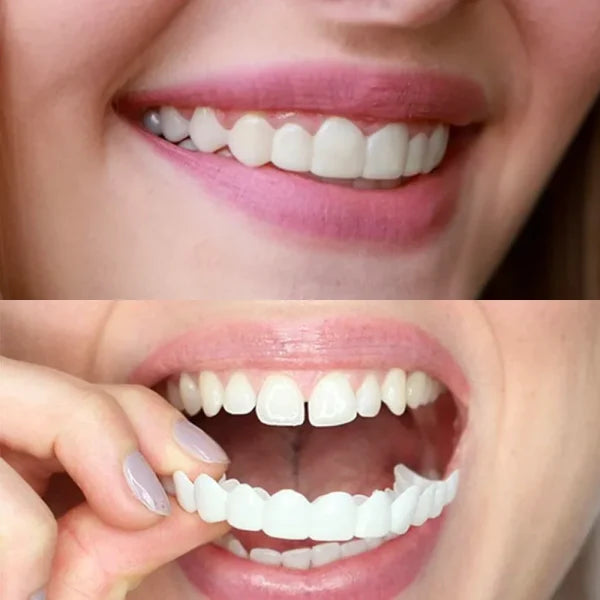 Snap On Smile Veneers (Upper & Lower Included)