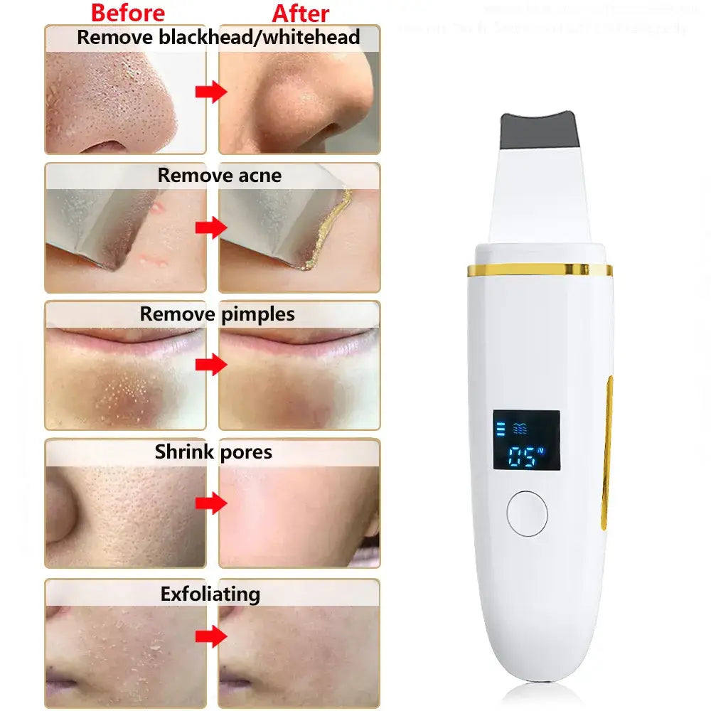 Ultrasonic Skin Scrubber Blackhead Peeling Remover