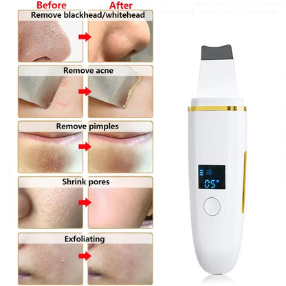 Ultrasonic Skin Scrubber Blackhead Peeling Remover