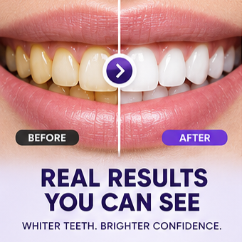 PurplePolish™ Pro Teeth Whitening Strips